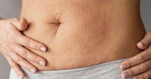 Beyond Imperfections: Embracing Stretch Mark Concealment